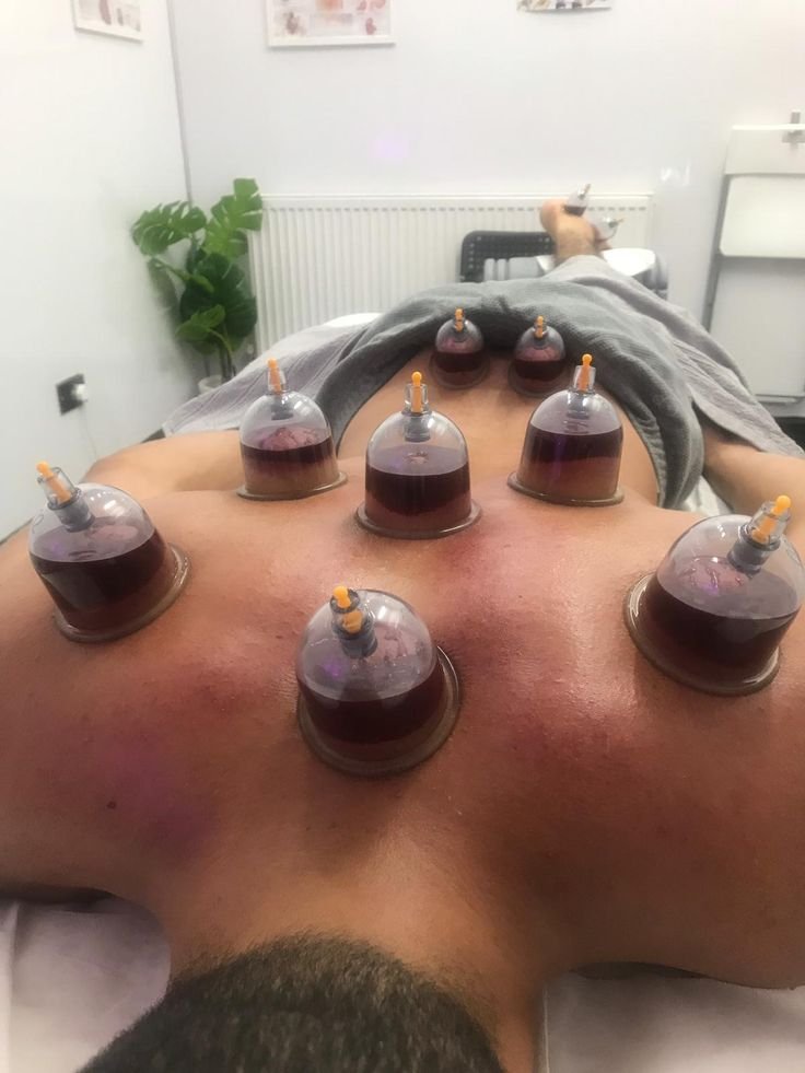 HIJAMA/ WET CUPPING